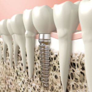 Dental implants