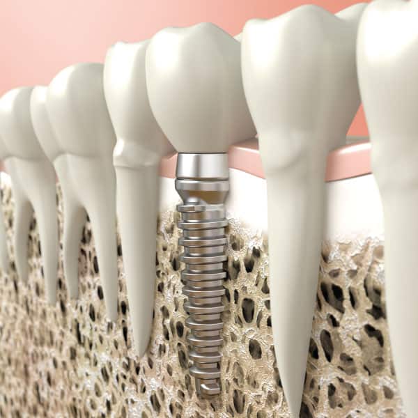 Dental implants