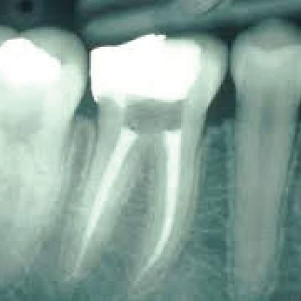 Root canal